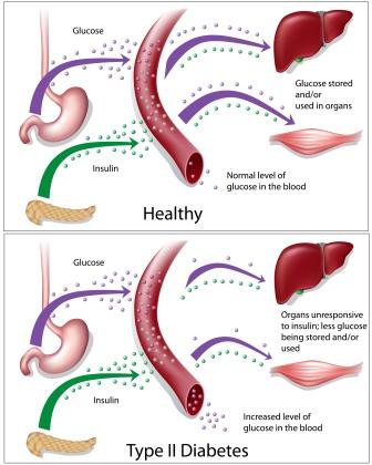 type 2 diabetes