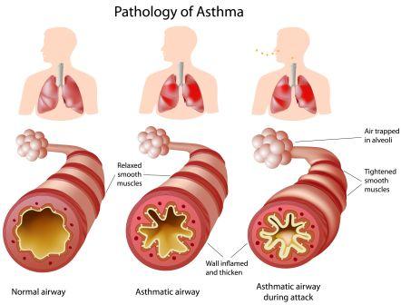 asthma