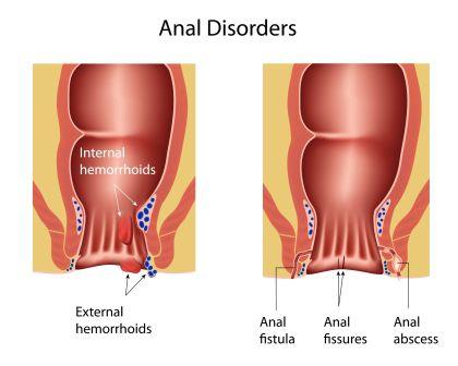 fistula piles abscess