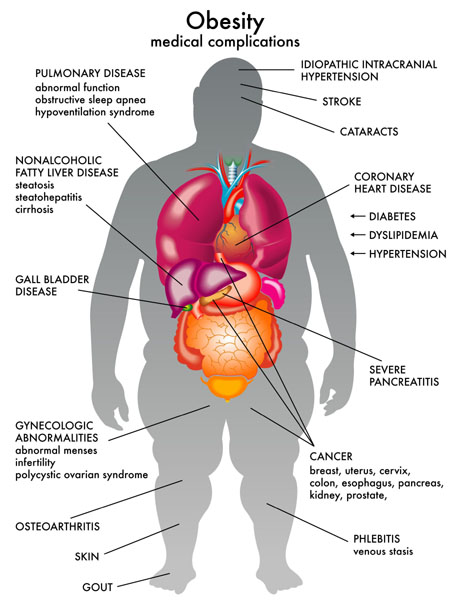 obesity complications