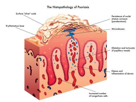 psoriasis