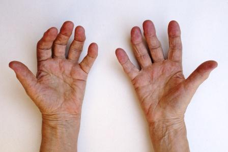 rheumatoid-arthritis-hand