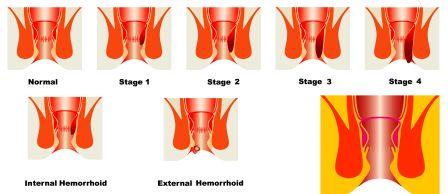 stages of hemorrhoids
